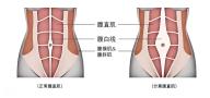 科普|腹部松弛？可能是“腹直肌分离”在作怪
